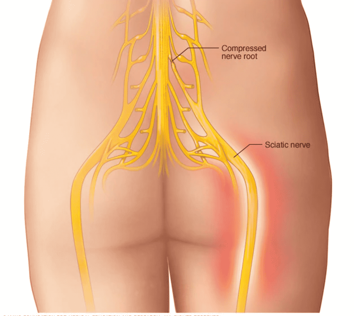 What You Need to Know About Sciatica - NJ's Top Orthopedic Spine & Pain  Management Center